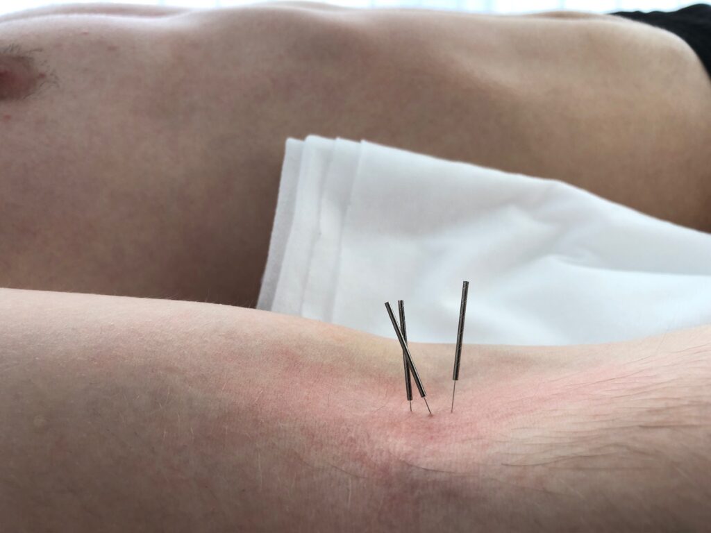 Gesetzte Akupunkturnadeln während einer Behandlung